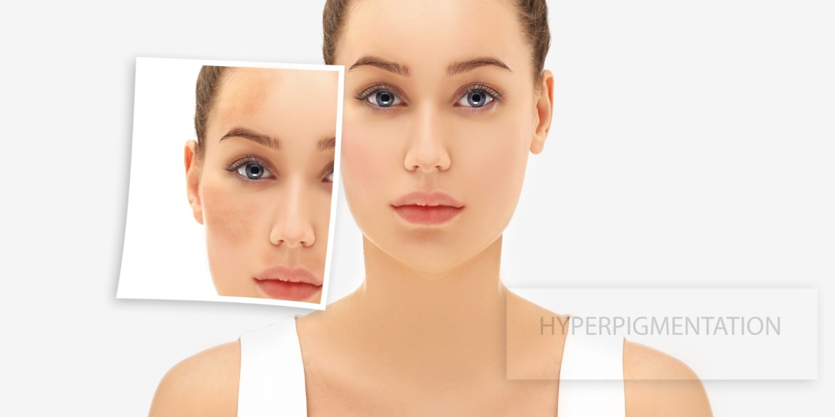 Hyperpigmentation: Causes, Treatments, And Prevention | Flourish Clinic